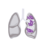 rak płuca